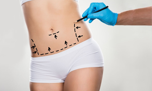 Package for Liposuction Upper Or Lower Abdomen 1 Area