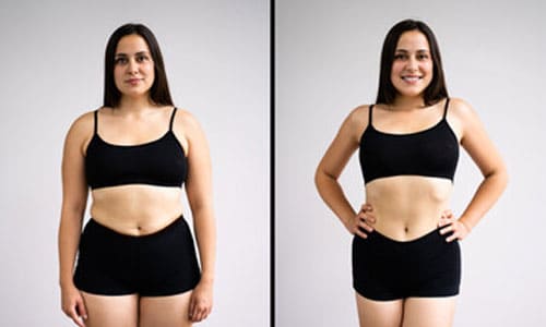 Paket für Mommy Makeover mit Tummy Tuck Brustverkleinerung und Fettabsaugung von Bauch und Taille