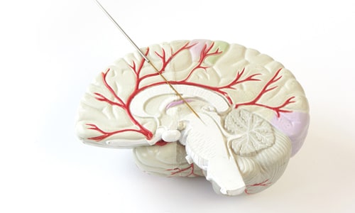 حزمة لجراحة التحفيز العميق للدماغ مع غرسة قابلة لإعادة الشحن