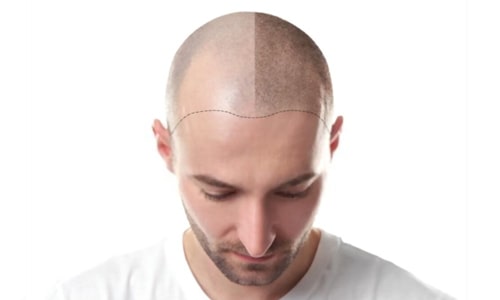 Package for Hair Transplant