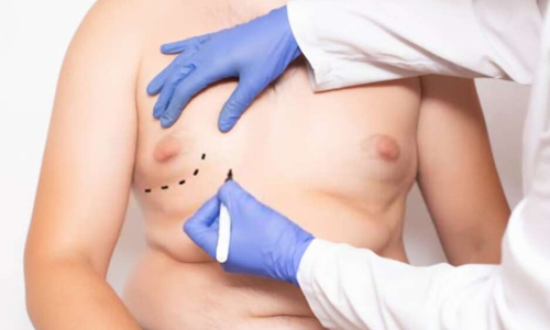 Пакет для операции по уменьшению груди у мужчин