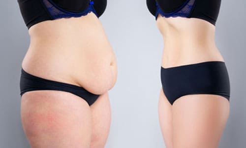 Package for Tummy Tuck