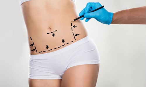Package for Abdominal Liposuction