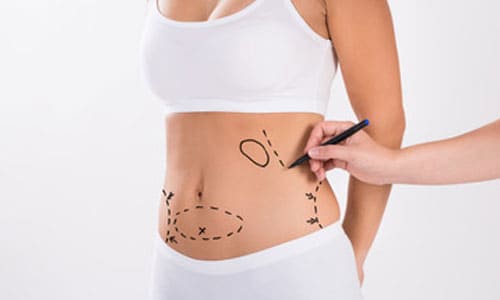 Package for Vaser Liposuction 3 Areas