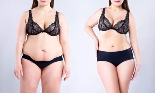 Package for Mommy Makeover with Tummy Tuck Breast Lift and Augmentation with Fats and Liposuction of Abdomen And Waist