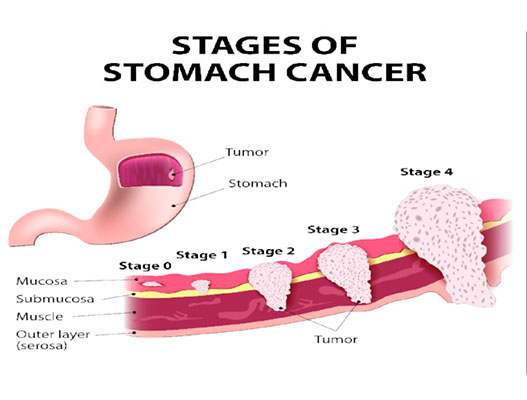 Stages of cancer. Pathoanatomy Stomach Cancer.