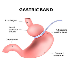 Lap Gastric Banding